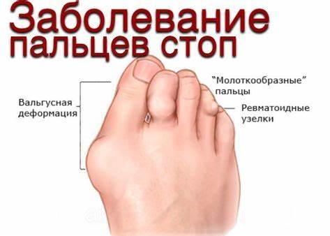 Подагра пальцев ног диета