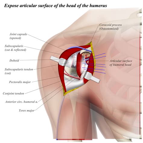 Shoulder Anterior Deltopectoral Approach Approaches Orthobullets