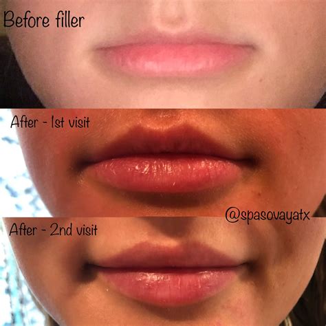What Is The Best For Lip Fillers Tad Horvath