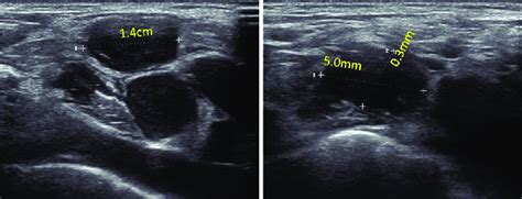 A Ultrasonography Of The Right Side Of The Neck Showing The Largest