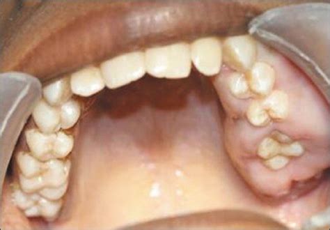 Massive Gingival Hyperplasia Covering All The Maxillary And Mandibular