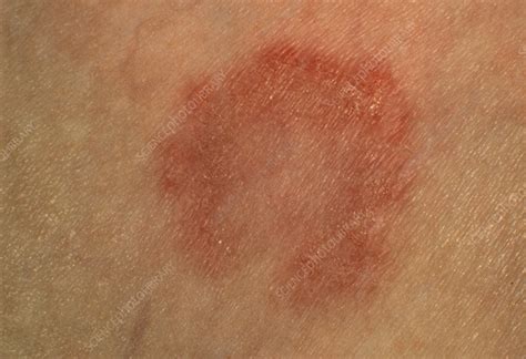 Tinea Corporis Ringworm Lesion On Skin Stock Image M2700169