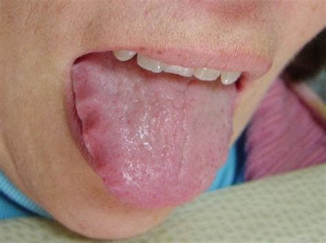 Scalloped Tongue