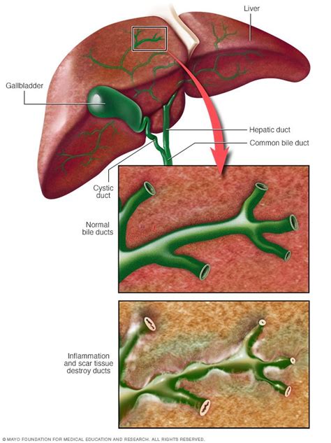 Primary Biliary Cirrhosis Disease Reference Guide