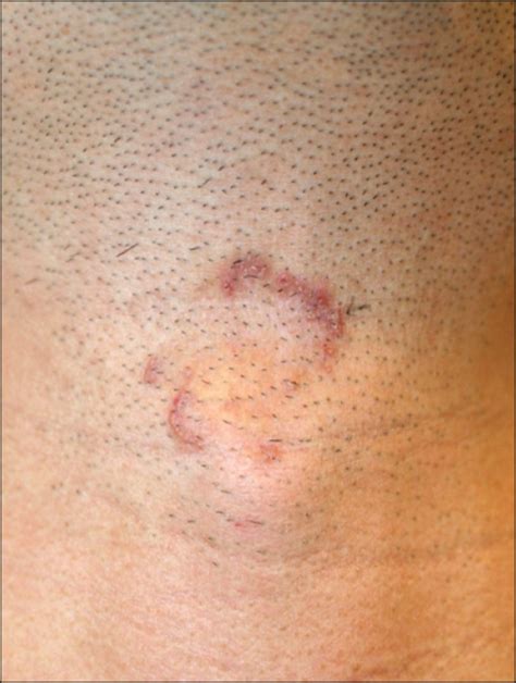 Crusted Erythematous Papules 25 Mm In Size Arranged In An Annular