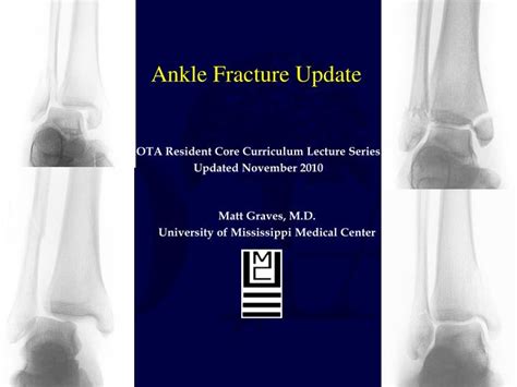 Ppt Ankle Fracture Update Powerpoint Presentation Free Download Id