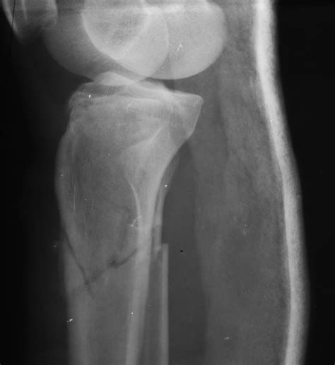 Proximal Tibia Fracture Image Radiopaedia Org