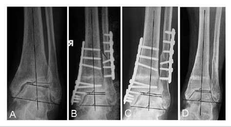 Supramalleolar Osteotomy With Or Without Fibular Osteotomy For Varus