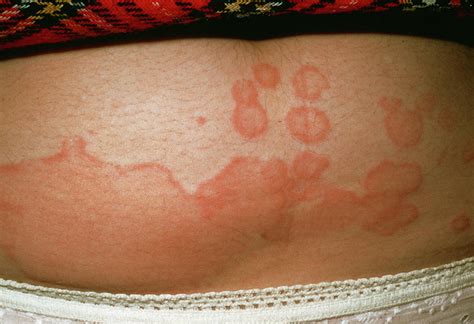 Urticaria Rash Photograph By Cnriscience Photo Library