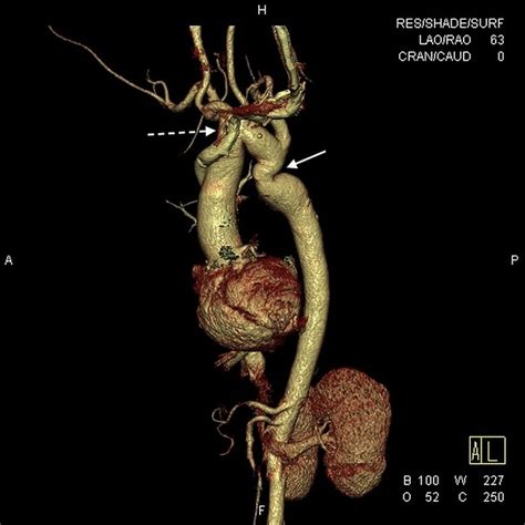 Aortic Pseudocoarctation A Late Presentation Of An Uncommon Anomaly
