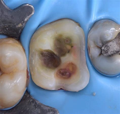 Management Of Upper First Molar With Large Amalgam Filling Myzerodonto