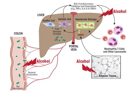 alcoholic liver disease pathogenesis and current management alcohol research current reviews