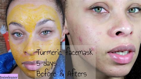 I Tried Turmeric Face Masks For Days Results Acne Prone Skin