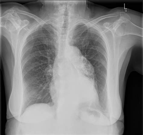 Thoracic Aortic Aneurysm Image Radiopaedia Org