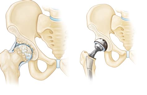 Total Joint Replacement Orthoinfo Aaos