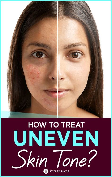 Uneven Skin Tone Tips To Get Rid Of It Naturally Uneven Skin Tone