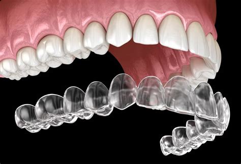 Tips On Caring For Your New Smile After Invisalign Treatment