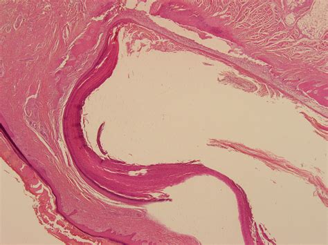 Pathology Outlines Epidermoid Inclusion Cyst