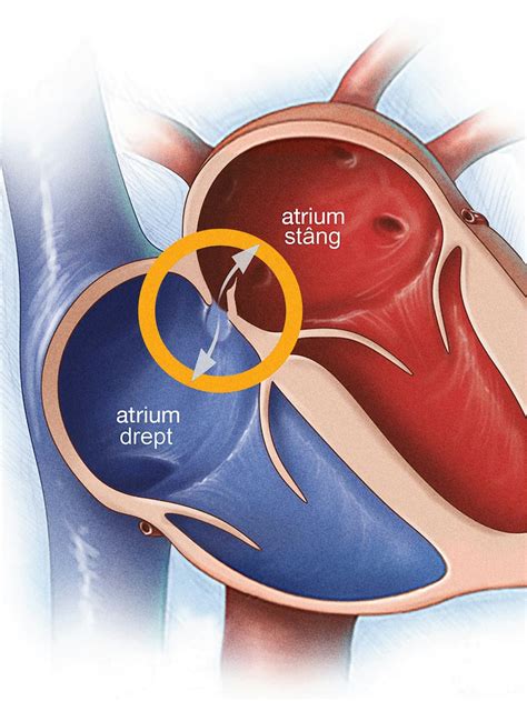 Foramen Ovale Patent Cauze Simptome și Tratament Ares