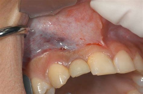 Infection After Dental Bone Graft Dental News Network