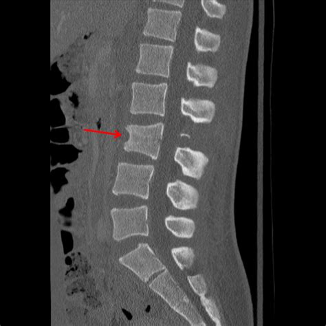 Fracture Of L1 Spine