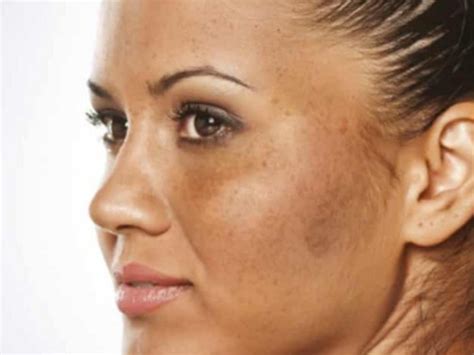 Hyperpigmentation Skincare Tips To Avoid Hyperpigmentation For Brown Skin
