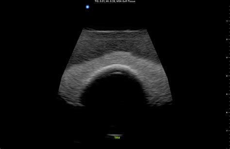 Thyroid Ultrasonography My Endo Consult