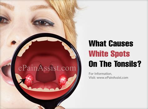 What Causes White Spots On The Tonsils How To Manage It