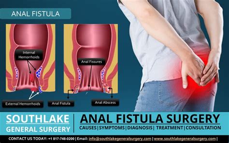 Anal Fistula Surgery