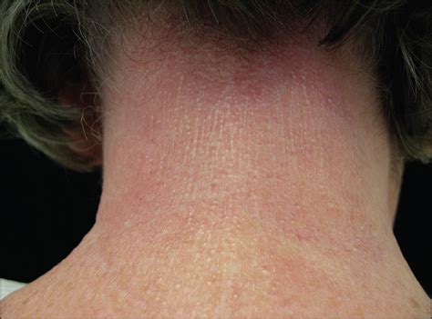 Diffuse Skin Thickening And Linear Papules In A 59 Year Old Woman—quiz