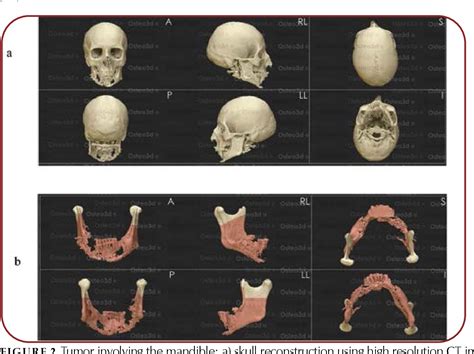 Figure From Ramus To Ramus Mandibular Defect Reconstruction With