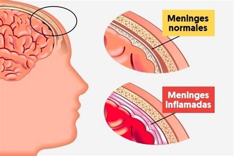 Meningitis meningocócica qué es síntomas y tratamiento Tua Saúde