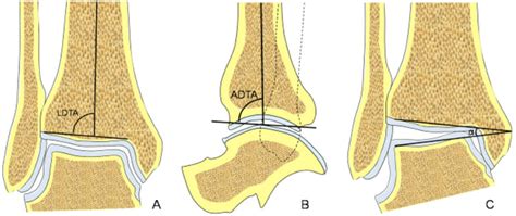 Pre Operative Measurement A The Lateral Distal Tibial Angle Ldta Is