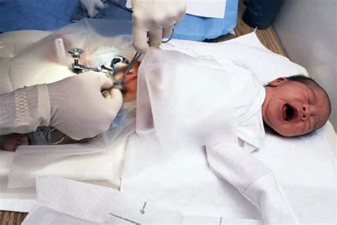 Circumcision Surgery You Know About It Amazefeeds
