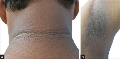 A And B Improvement In Acanthosis Nigricans After 2 Months Of