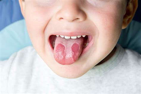 Chingum — Discover Curiosities The Cracks On The Tongue And Is It Dangerous
