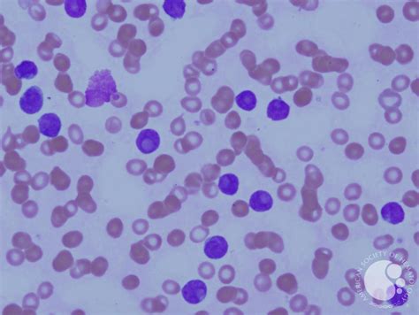 Figure 1 Peripheral Blood Smear At 50 X Magnification