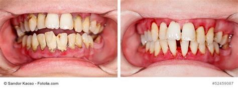 Zur Ckgehendes Zahnfleisch Ursachen Und Gegenmittel