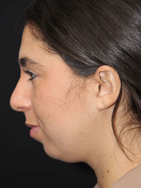 Patient Chin Implants C25 Solomon Facial Plastic