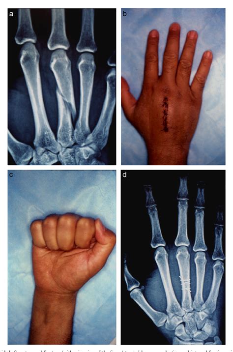 Long Obliquespiral Mid Shaft Metacarpal Fractures Of The Fingers