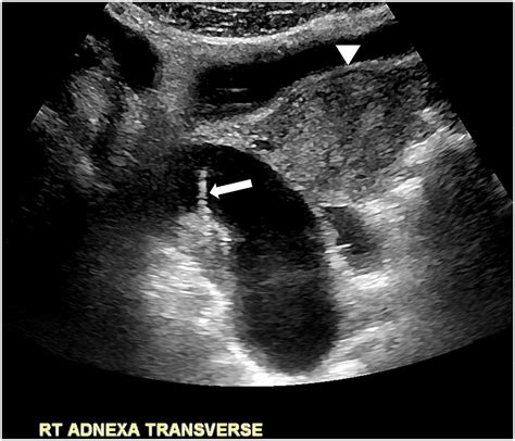 Isolated Fallopian Tubal Torsion A Challenging Ultrasound Diagnosis