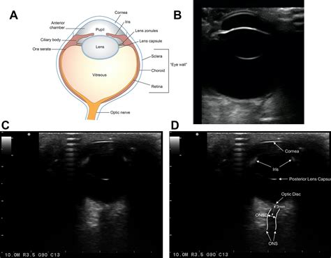 Ocular Ultrasound Abnormalities And Optic Nerve Sheath Diameter In Dogs