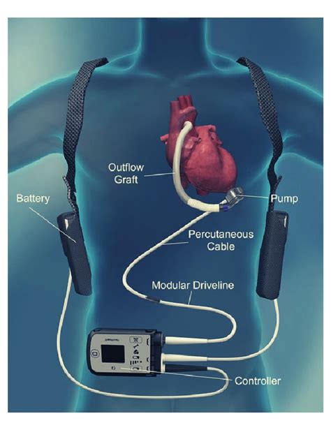 Lvad Device Ventricular Assist Device Implant And Surgery