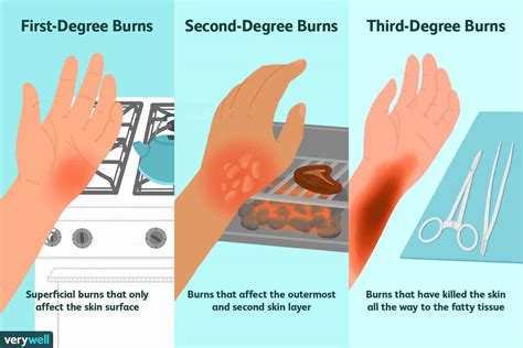 Frist Aid For Burns Dr Joann Child Specialist