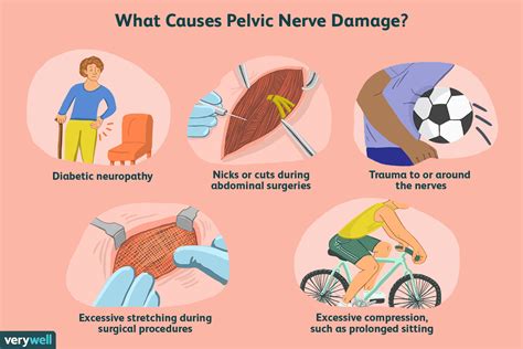 What Causes Pelvic Nerve Pain