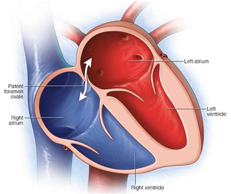 Patent Foramen Ovale Causes Symptoms Diagnosis And Treatment