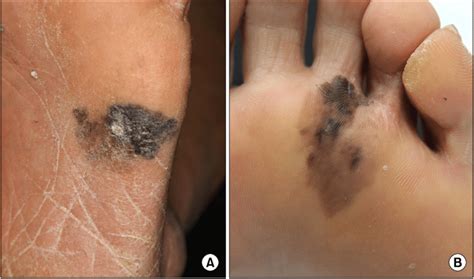 Acral Lentiginous Melanoma Metastatic Melanoma