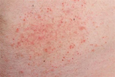 Does Your Gluten Rash Look Like These 5 Photos Gluten