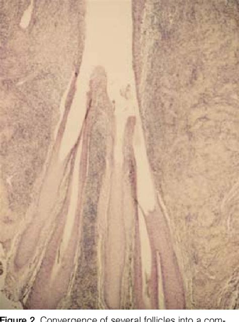 Figure 3 From Tufted Hair Folliculitis After Scalp Injury Semantic