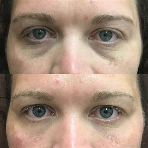 Tear Trough Fillers Before And Afters Oklahoma City Okc H Md